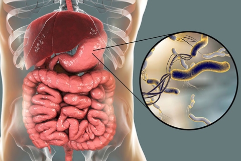 Wadudu Wanaosababisha Vidonda vya Tumbo (H. pylori)